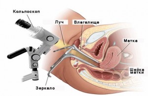 Кольпоскопия – исследование шейки матки