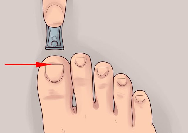Как избавиться от вросших ногтей
